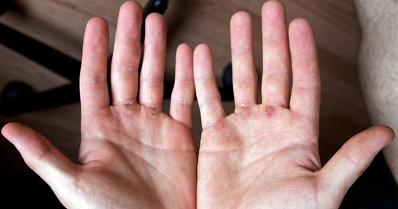 5 Tips on How to Control Your Calluses